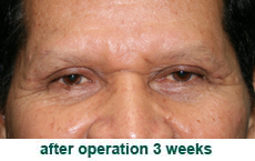 plastic-surgery-blepharoplasty